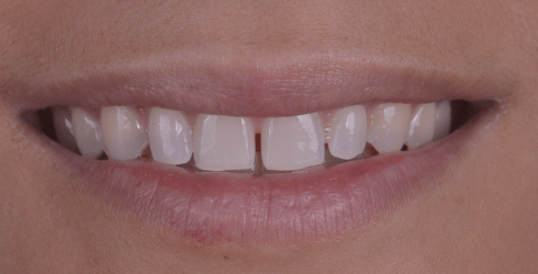 Facettes dentaire