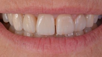 GAD Cabinet dentaire : réhabilitation prothétique antérieure