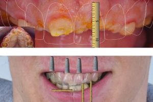 GAD Cabinet dentaire à Bordeaux : implants