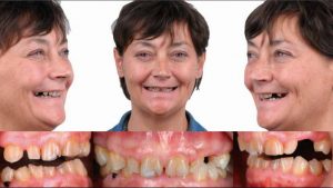 GAD Cabinet dentaire à Bordeaux : Restauration implantoprothétique antérieure