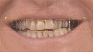 Apport du digital smile design dans la communication orthodontiste – dentiste