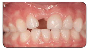 GAD Cabinet dentaire : le cantilever pédiatrique