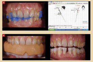 TECHNIQUE DE RÉHABILITATION PROTHÉTIQUE OCCLUSO-ESTHÉTIQUE