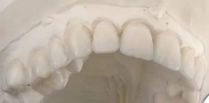 Réhabilitation esthétique du point de vue clinique et de laboratoire