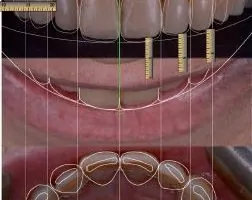 Le Smile Design : un outil pour la planification des traitements esthétiques et fonctionnel