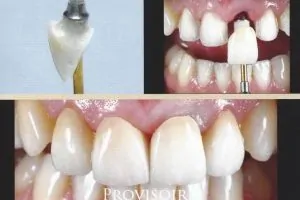GESTION DU SECTEUR ANTÉRIEUR SUR DENTS ET IMPLANTS