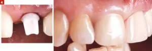 RELATION IMPLANT PROTHÈSE